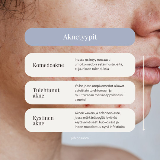 Acne Control - Kystisen ja komedoaknen tuotepaketti